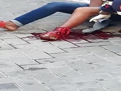 Man in agony with leg shattered after accident 