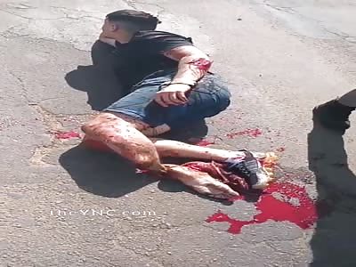  motorcyclist with a shattered leg after accident  