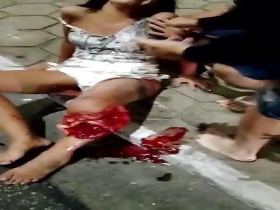 Poor Lady Got Leg Damaged in Accident 