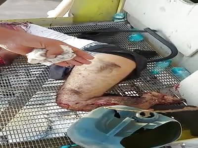 Man in agony after accident.