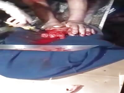 DAMN! They Took a Little More Than His Fingers