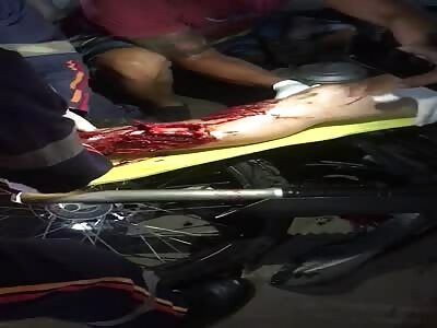 pain. with the leg shattered after an accident 