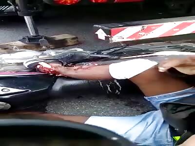 pain and suffering with shattered leg after accident