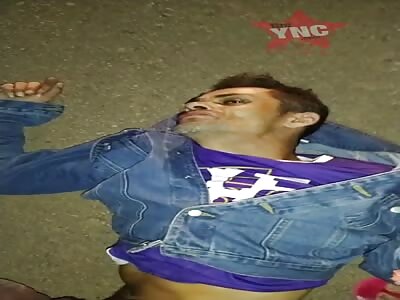 dismembered hand and leg after accident 