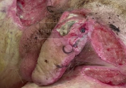 Russian wounded soldier hospitalized 