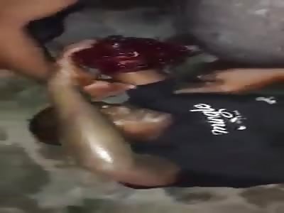 Trying To Stop Bleeding From Missing Arm