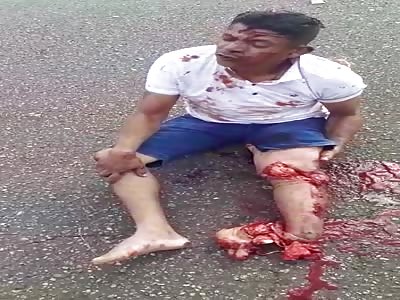 You Just Lost Your Leg In An Accident, Let Me Interview You!