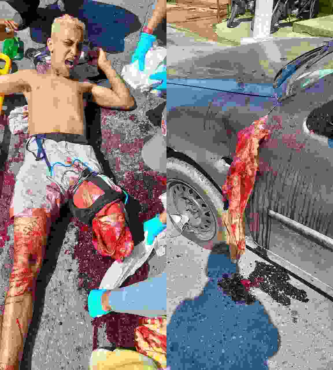 Biker's Leg Gets Ripped Off And Stuck In Car