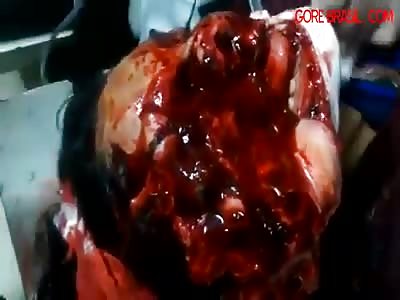 Severely injured after accident