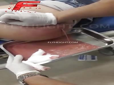 When butt injects go wrong...