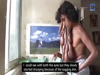 Elephant Man with â€œTrunkâ€ Due to Rare Condition is Revered as a God