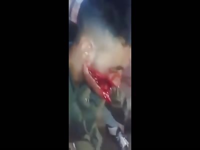 Man with face disfigured in terror attack in istanbul