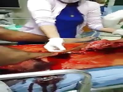 Man loses leg in accident