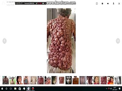 My first video slides warts