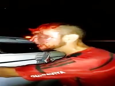 Man pulls off the top of his head in an accident