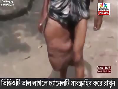 man with horrible leg disease