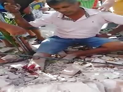 accident with people one man is buried and another loses his foot