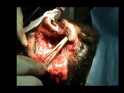 An operation of jaw surgery with an eye severe injured