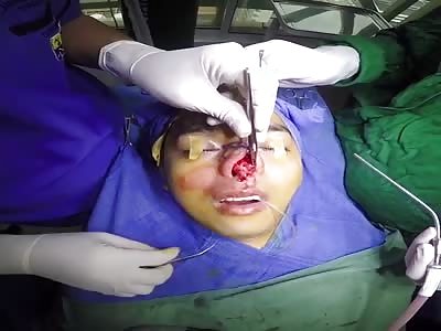 This procedure involves removing cartilage from the septum of the nose to so that it can be used for grafting purposes. 