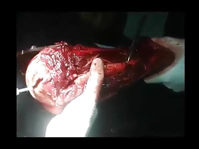  Severely damaged arm and fracture