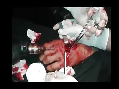  Suffering From Bombing Injuries