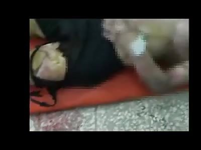 Cases Of Serious Burning Result