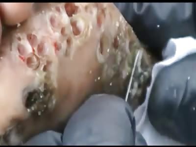 African jiggers disease