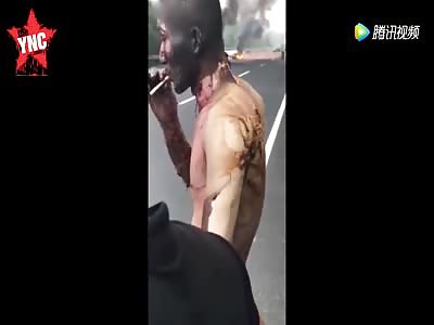 a man says he feels no pain after being in bad car crash with burns all over his body