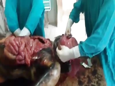 Bloated Drowned Guy Autopsy