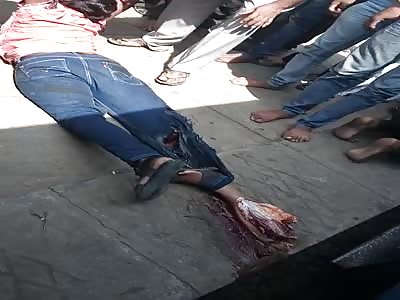 Suicide Fail: Man Wanted to Lose his Life but he Only Lost one Leg