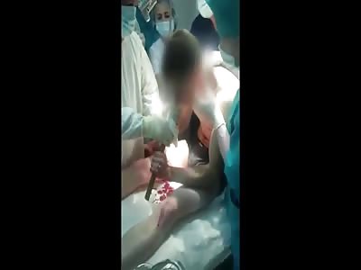 Remove the Steel Bar Embedded in the Face ...