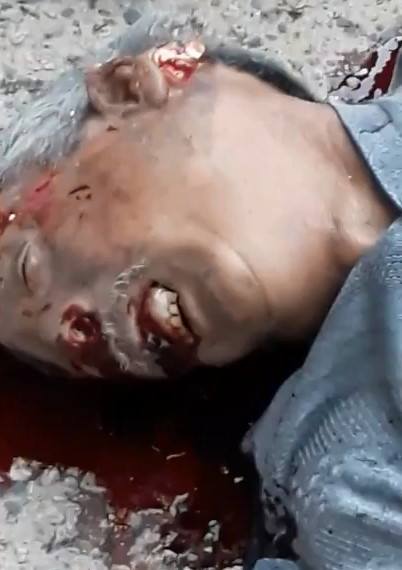  Motocycliste Agonizes After the Accident Missing half his Brain...