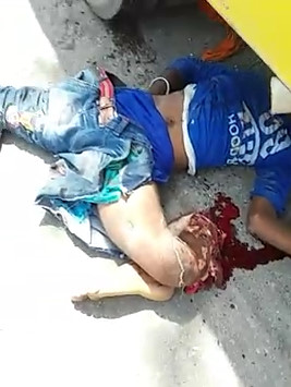 Mangled Leg in Hard Accident 