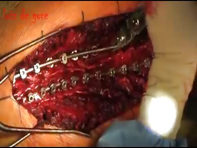 Correction of scoliosis using differential 