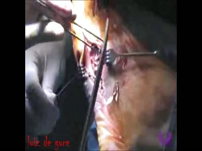 Diabetic Foot Surgery