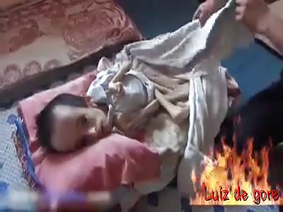 YOUNG WITH MALFORMATION 