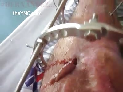 Draining blood with pus on man's leg