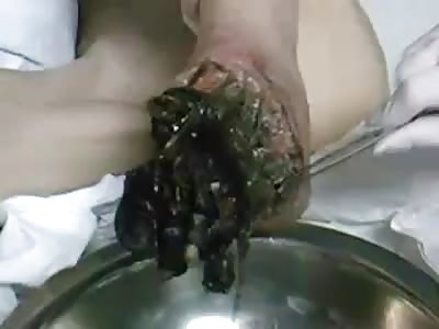 Horrible pictures foot with necrosis