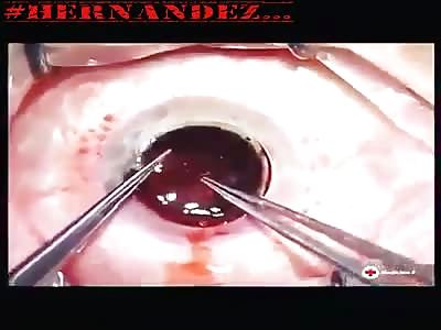 Contact lens placement