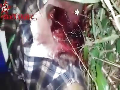 Brutal injury in motorcycle accident