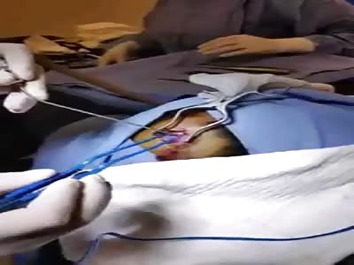 Remove cyst