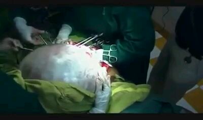 Gigantic tumor in the stomach