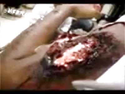 Emergency room burned woman