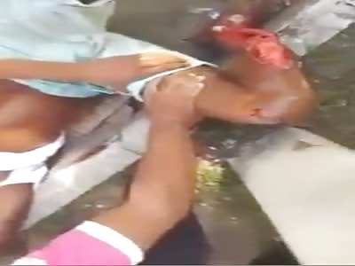 Man has terrible leg injury.