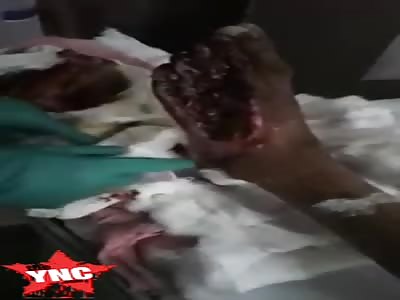 Foot ripped in half after accident.