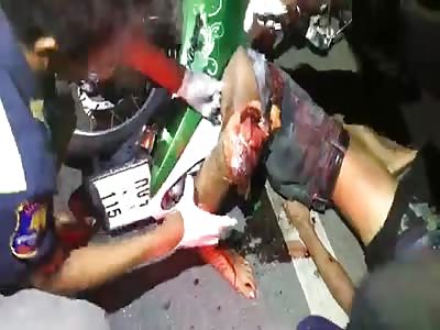 Youths leg torn open and embedded in motorbike frame