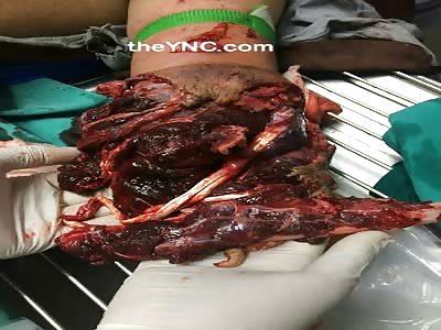 (Pics) Man Blew His Arm off With a Hand Grenade