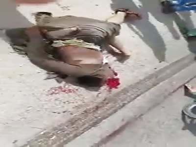 Broken Bones Aftermath...