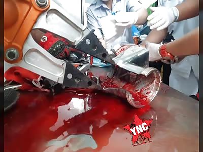 Accident of work hand stuck in mill