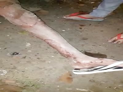 Injured by gas explosion